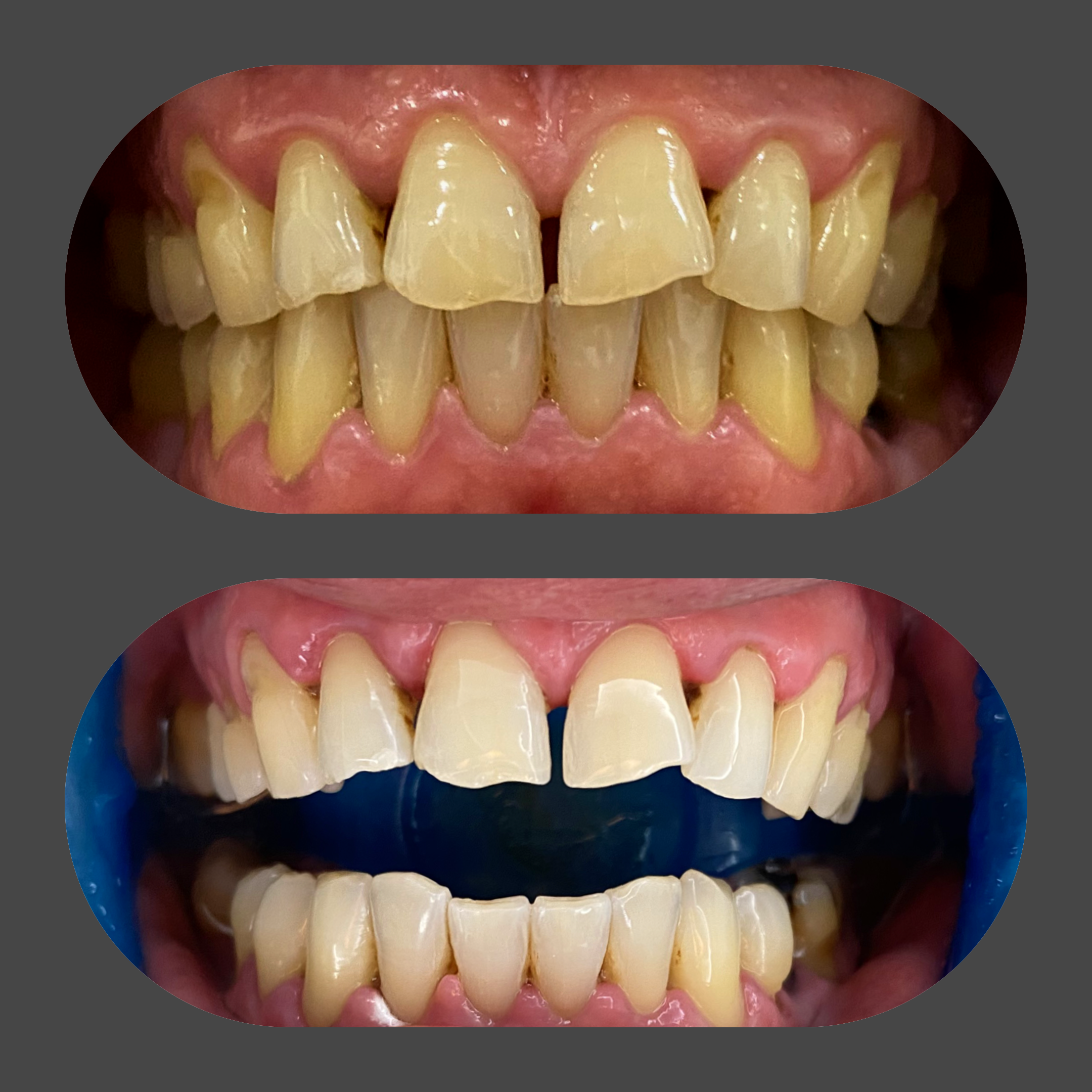 Teeth whitening before and after