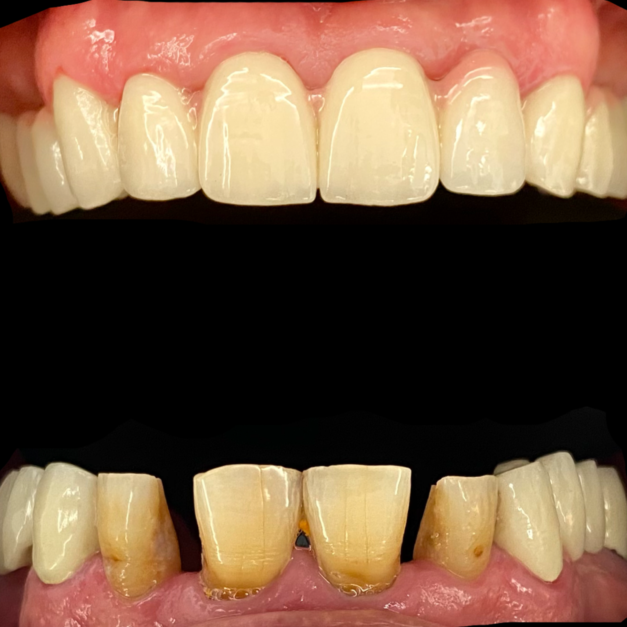 Zirconia treatment before and after